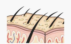 新生植髮：脱髮部位的細小絨毛怎麼長成頭髮?