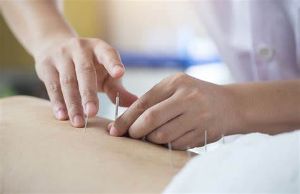 針灸的好處