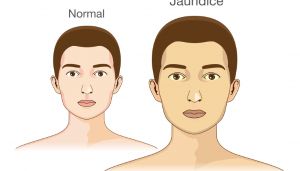 過量的維生素A會使皮膚變黃嗎