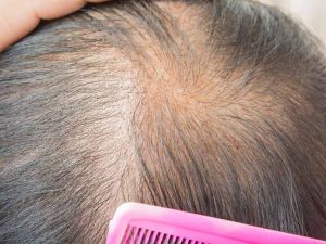 瀰漫性脱髮的原因是什麼