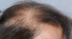 如何治療瀰漫性脱髮？