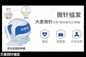大麥微針植髮：最近掉頭髮突然增多的原因