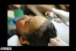 貞韓植髮：植髮1個月後頭髮又掉了，還能重新長出來嗎?