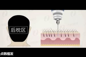 貞韓植髮：植髮後，額頭出現水腫正常嗎?該怎麼辦？