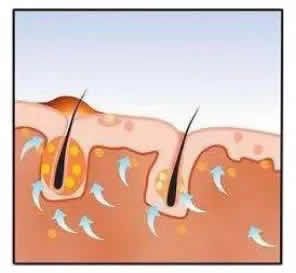 北京大學國際醫院：防治毛囊炎，妙招3步走~