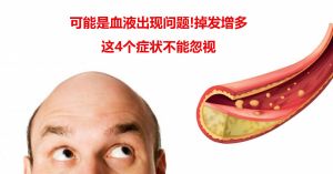 碧蓮盛植髮：可能是血液出現問題!掉髮增多+這4個症狀不能忽視