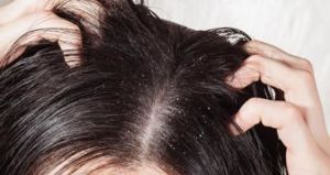 頭部脂溢性皮炎的症狀和治療方法