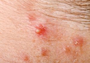 毛囊炎疙瘩圖怎麼消除