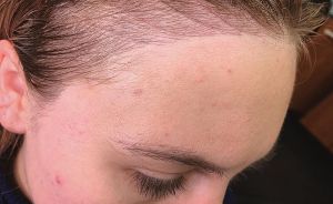 頭髮扎太緊會導致髮際線後移嗎？