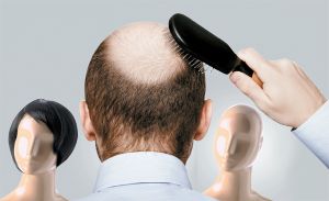 男性也會出現女性雄性脱髮！雄性脱髮治療診斷大解密