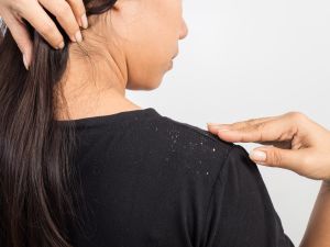 頭皮屑愈洗愈多?沒想到這樣洗髮全錯了