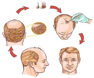 植髮手術常見Q&A