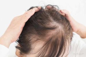 頭髮變薄要注意!4大重點分析脱髮成因、預防治療方法