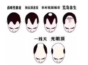 【脱髮】未老先衰4大脱髮類型