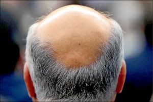 防脱偏方多 營養均衡才是王道