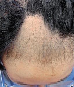 拔毛癖是什麼原因造成的