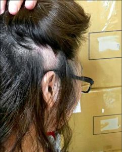 根治「鬼剃頭」舒緩壓力很重要