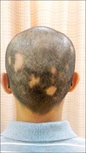 年紀輕輕鬼剃頭 中醫有辦「發」