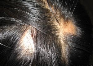 52歲婦女突然鬼剃頭 針灸長出新髮