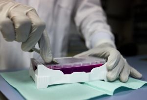 研究：3成患者染疫愈後留遺症 累、焦慮甚至掉髮