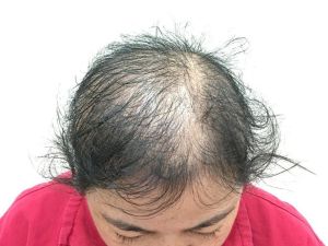 年輕女生狂掉髮 半數減重造成