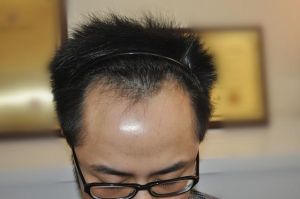 按摩梳頭依舊禿頂 靠植髮救M字額