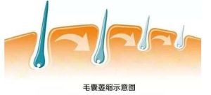 搶救毛囊 別等掉髮後…