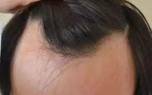 發線後退、掉髮增多 最好快看皮膚科