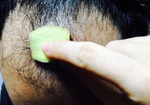 28歲男為了治禿頂抹生薑、擦啤酒