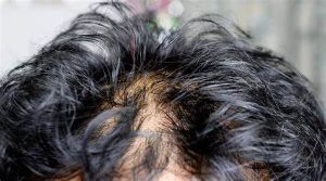 掉髮Q&A/頭皮油、常綁發 容易禿?