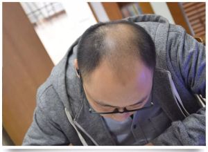 高中生像大叔…雄性脱髮年輕化