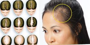 微量雌激素噴劑治雄性脱髮 效果有限