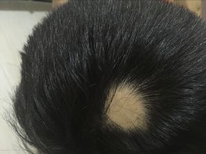 圓形禿 並有免疫病機率高