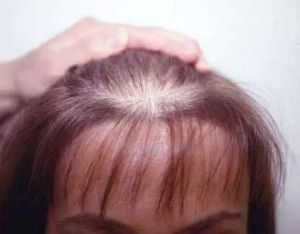 頭皮提早老化?小心髮量不保!