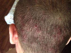 頭皮長痘痘?脂溢性毛囊炎作怪