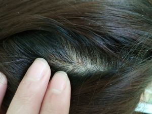 頭皮屑是什麼？