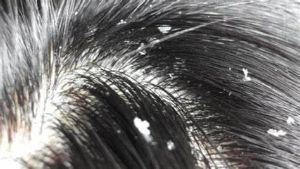 什麼是脂溢性皮膚炎