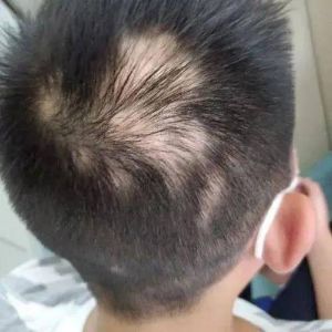 虎爸打罵壓力大 4歲童嚇出圓形禿