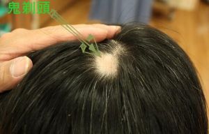 一夕之間頭髮就禿了一大塊 發生「鬼剃頭」該怎麼辦？