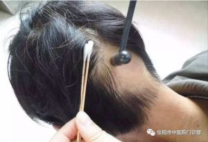 七星針(梅花針)叩刺，治療斑禿、髮際線後移