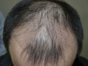 季節交替 雄性脱髮增二成