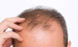研究：脱髮者治療四月 頭髮平均再生92%