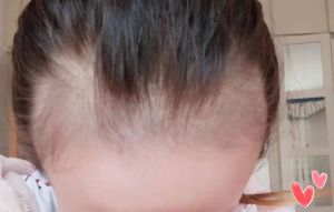 產後脱髮不用慌 瞭解產後脱髮原因是什麼