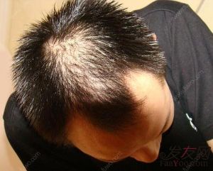 男性脱髮——少年老成的煩惱