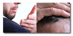 頭皮屑與乾癬皮屑如何分別？去屑洗髮水怎麼選？ 7個日常習慣讓您輕鬆保養與預防！