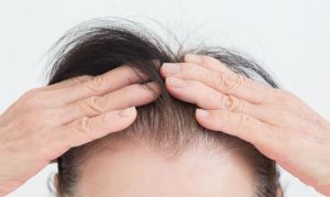 你是高額頭還是前額禿?小心髮際線後移這是禿頭信號!