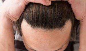 別讓發線崩壞顏值！拯救前額脱髮關鍵在這幾點