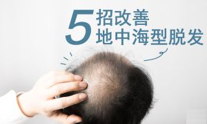 精選五招！改善地中海型脱髮