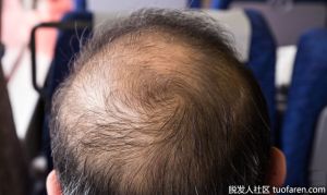 預防脱髮：改善掉髮的６種生活習慣！