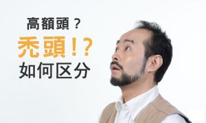 【解惑】高額頭?禿頭? !到底該如何區分